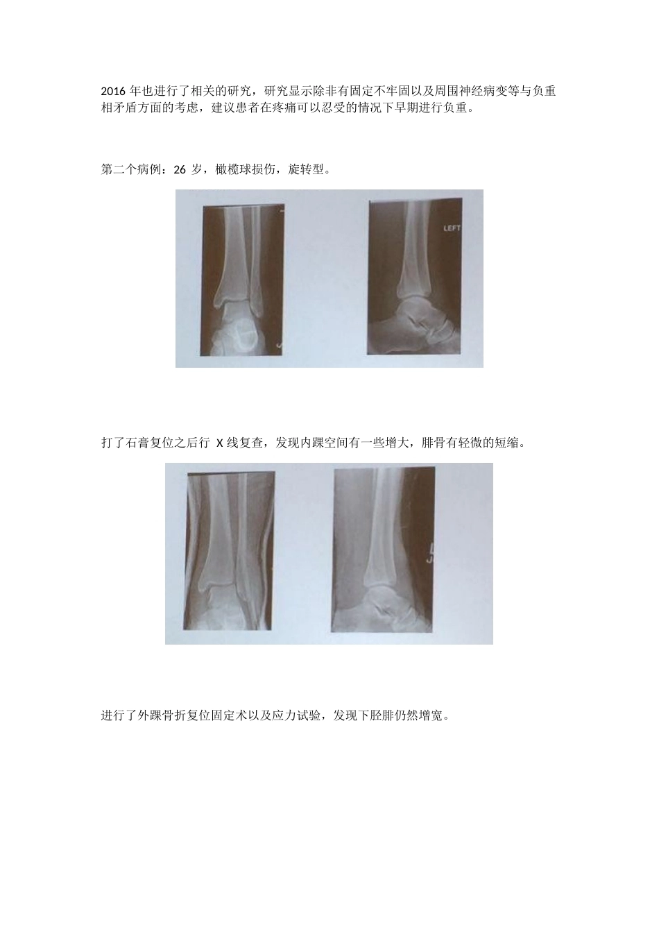 踝关节骨折后到底什么时候负重_第4页