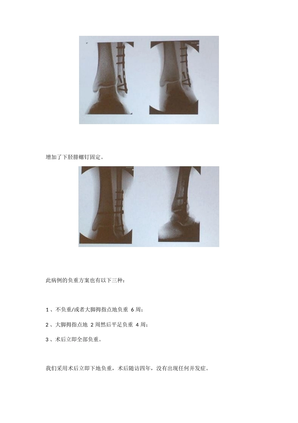 踝关节骨折后到底什么时候负重_第5页