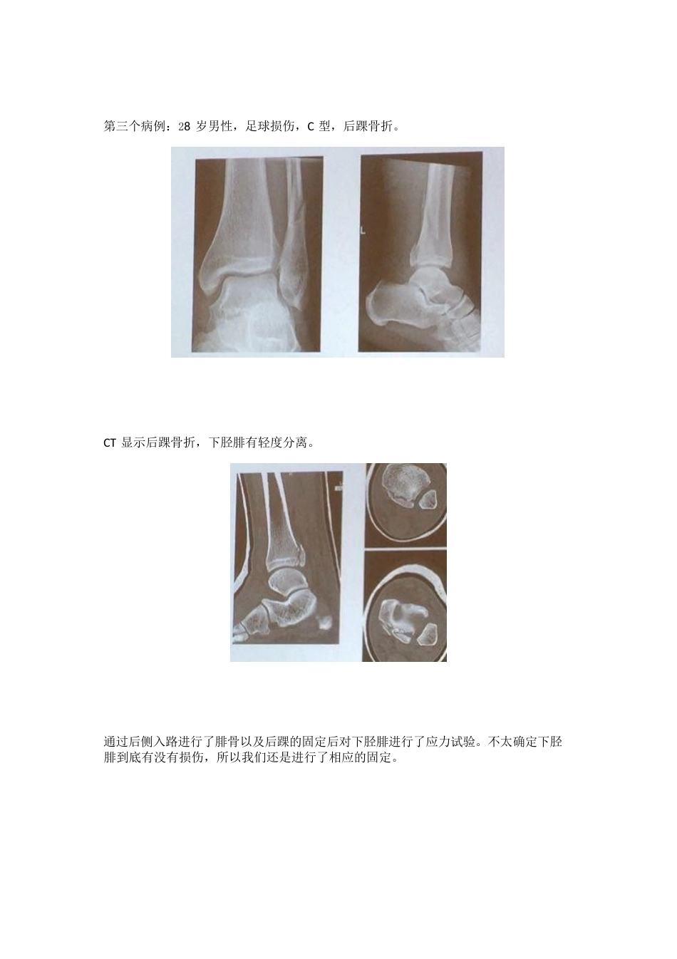 踝关节骨折后到底什么时候负重_第6页