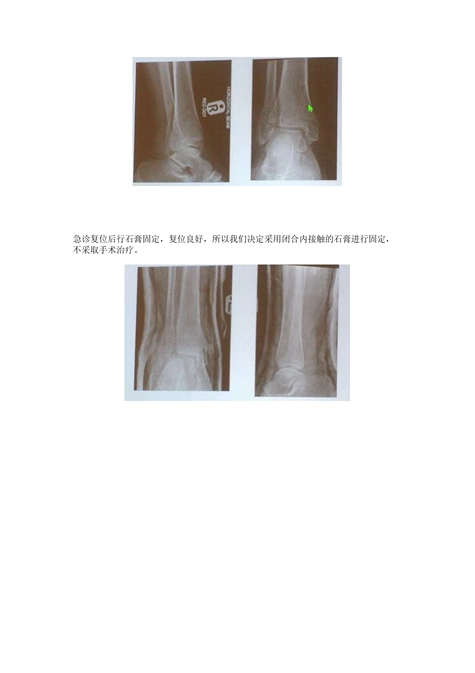 踝关节骨折后到底什么时候负重_第8页