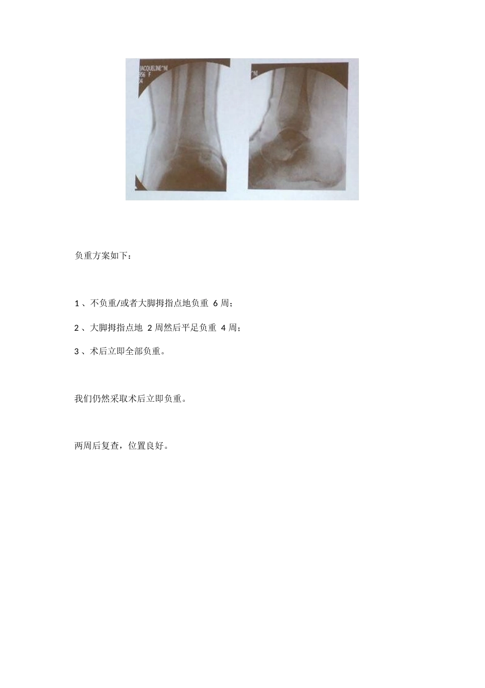 踝关节骨折后到底什么时候负重_第9页