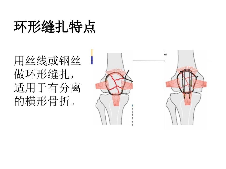 髌骨骨折_第15页