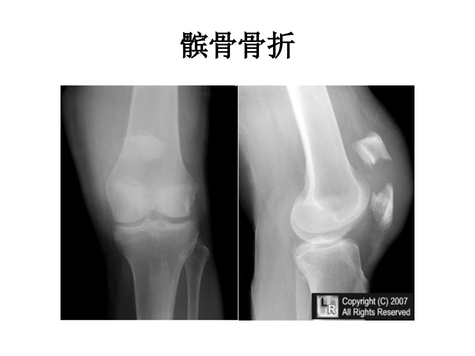 髌骨骨折_第5页