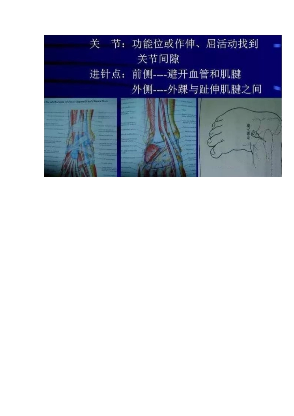 各关节腔穿刺 方法技巧大全_第10页