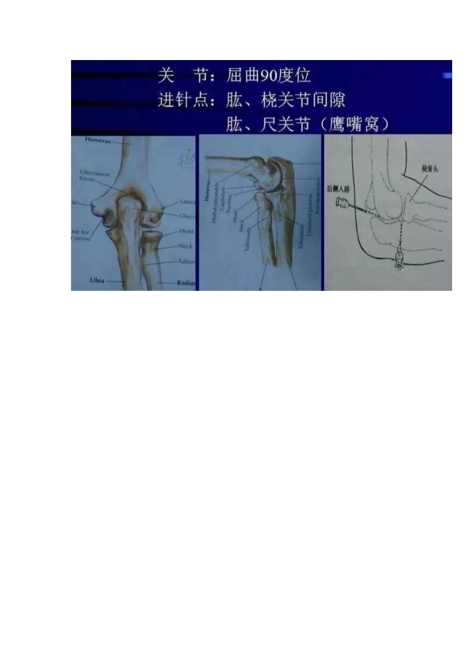 各关节腔穿刺 方法技巧大全_第11页
