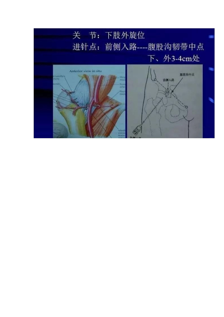 各关节腔穿刺 方法技巧大全_第12页
