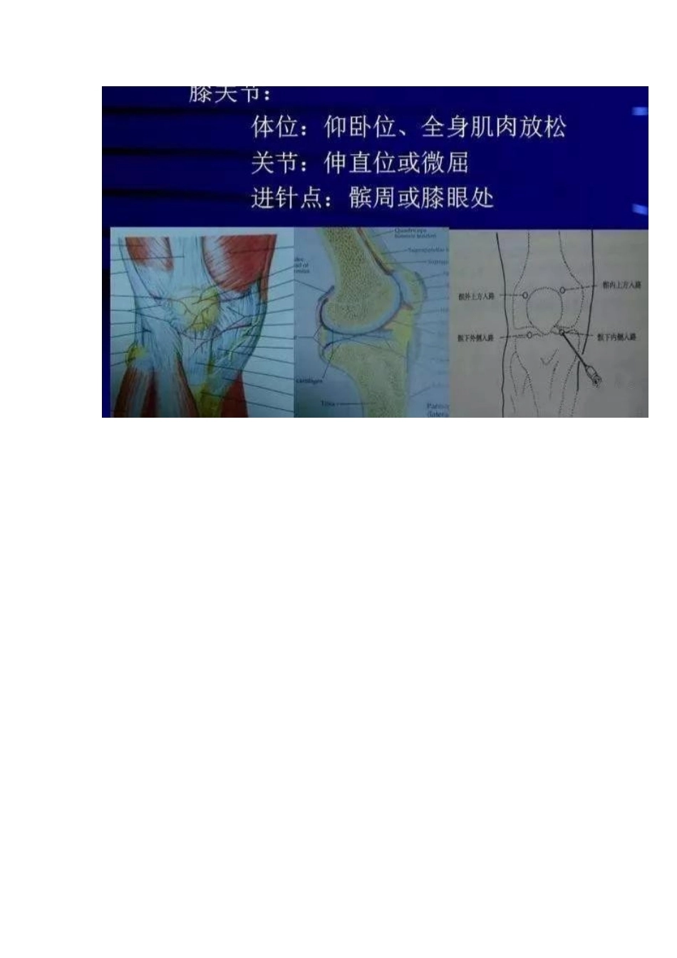 各关节腔穿刺 方法技巧大全_第3页