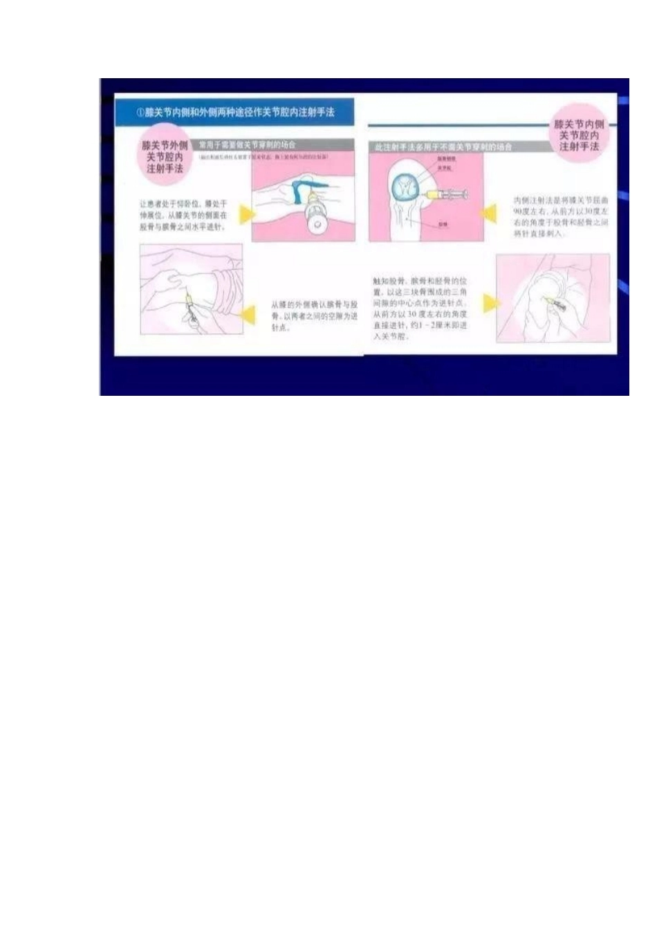 各关节腔穿刺 方法技巧大全_第4页