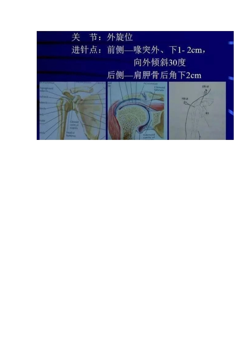 各关节腔穿刺 方法技巧大全_第6页