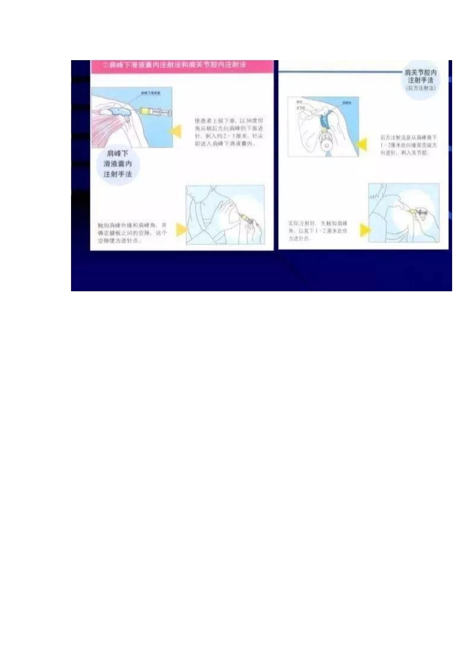 各关节腔穿刺 方法技巧大全_第7页