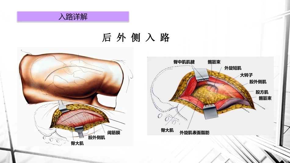 人工全髋关节置换术后 脱位_第11页