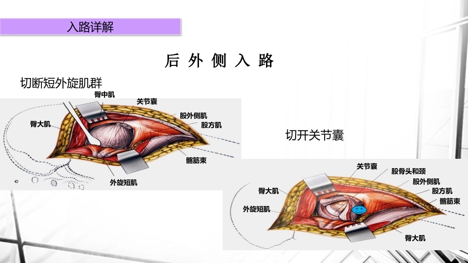 人工全髋关节置换术后 脱位_第13页