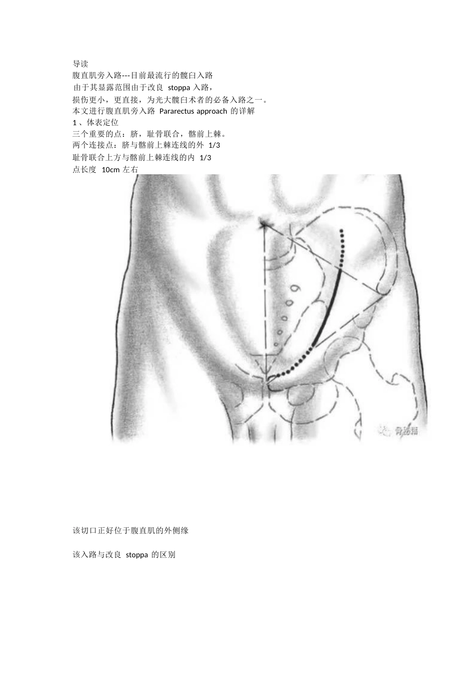 髋臼的必备入路腹直肌旁入路_第1页