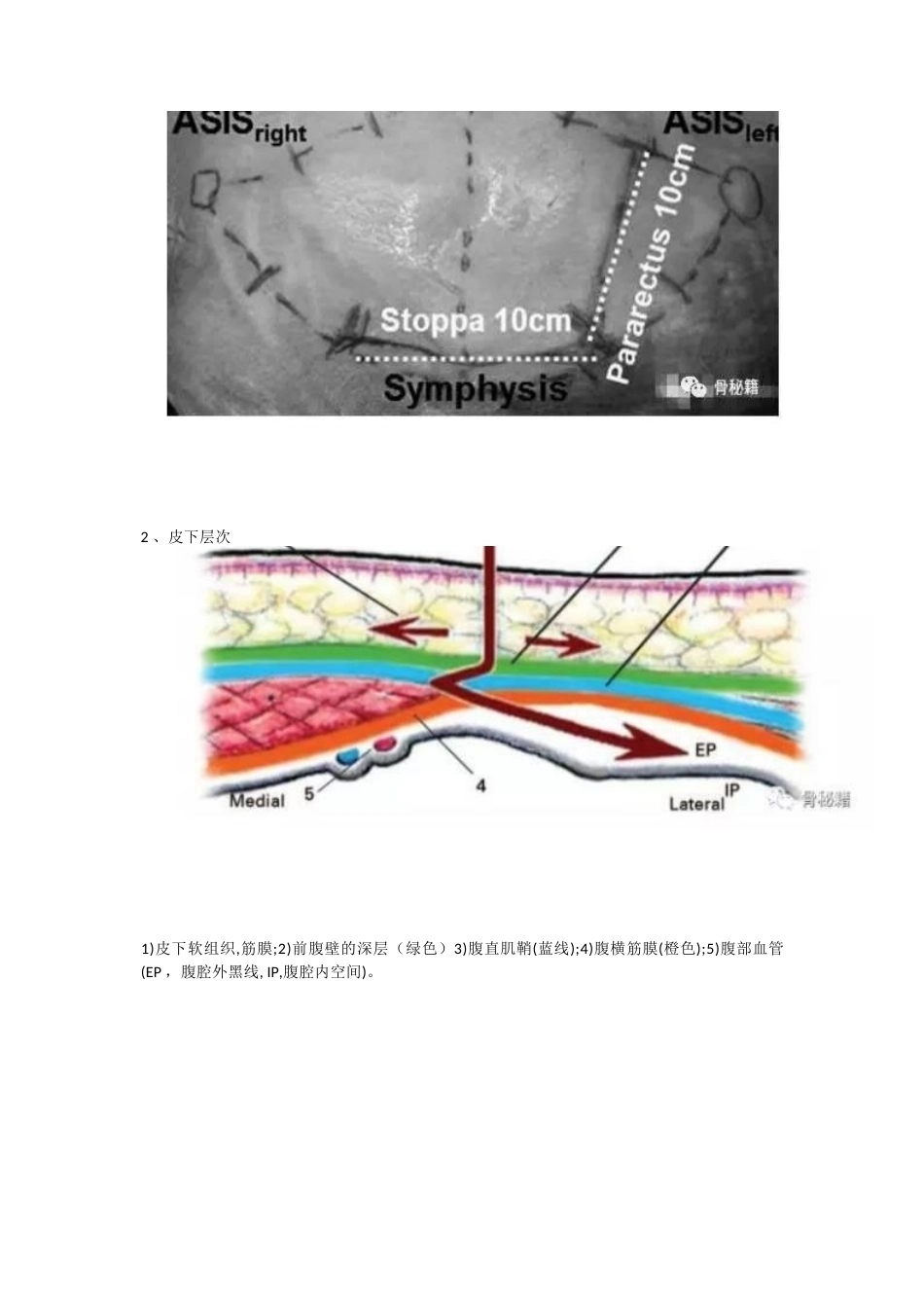 髋臼的必备入路腹直肌旁入路_第2页
