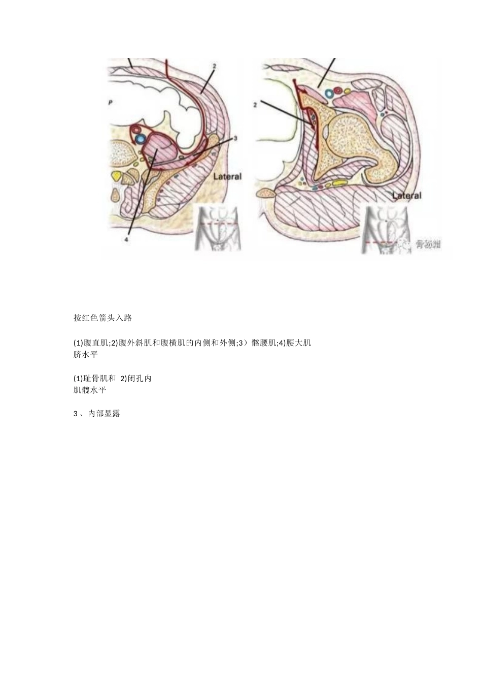 髋臼的必备入路腹直肌旁入路_第4页