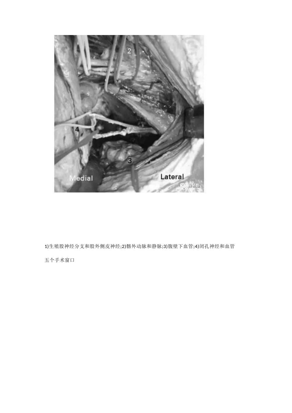 髋臼的必备入路腹直肌旁入路_第6页