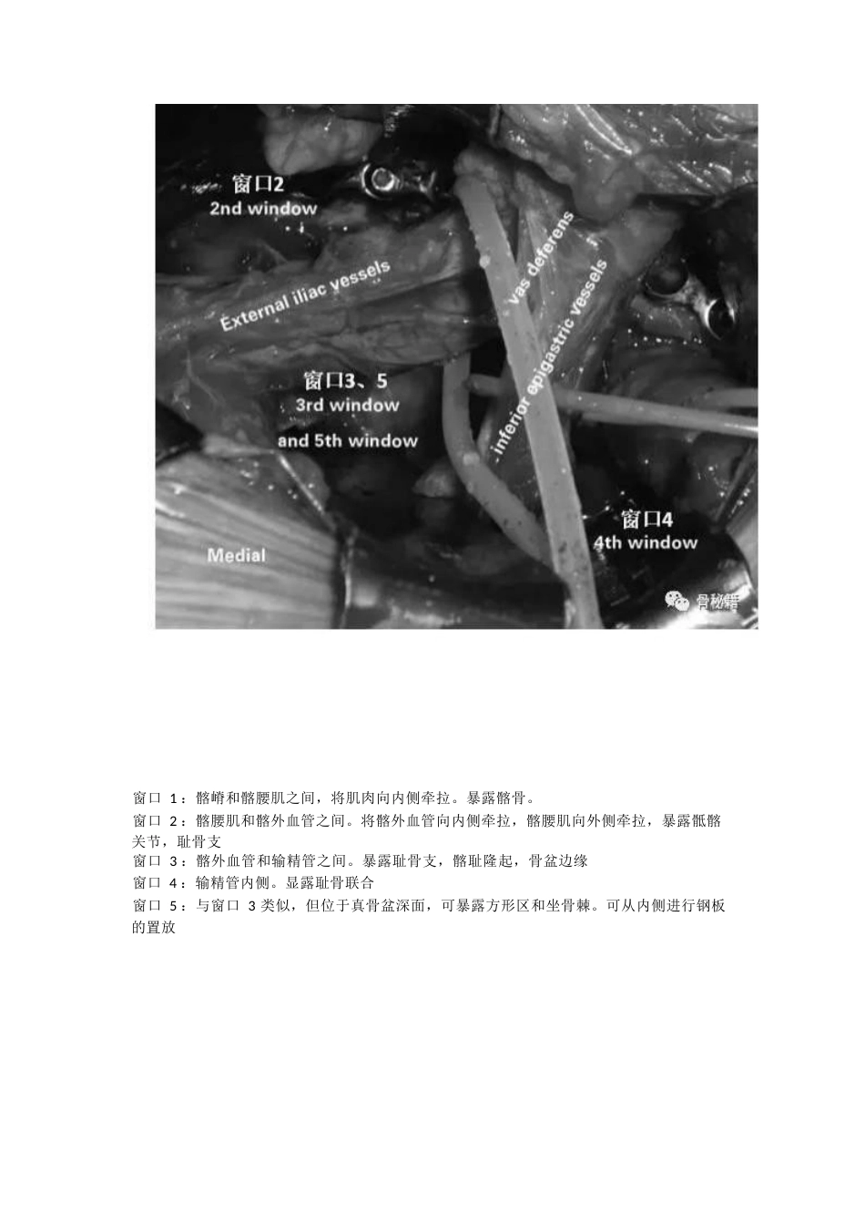 髋臼的必备入路腹直肌旁入路_第7页