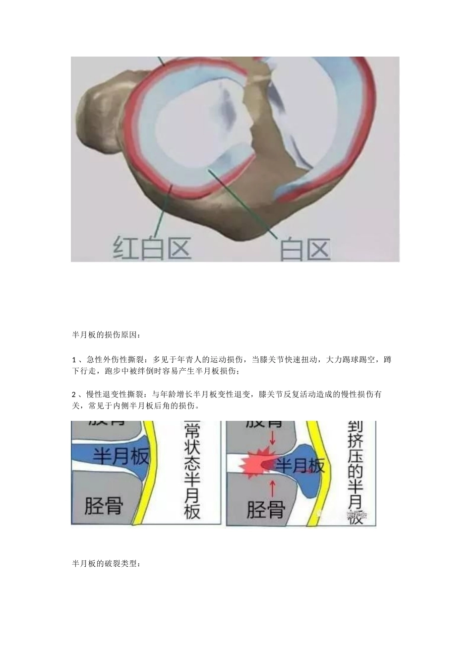 半月板的损伤 及治疗_第3页