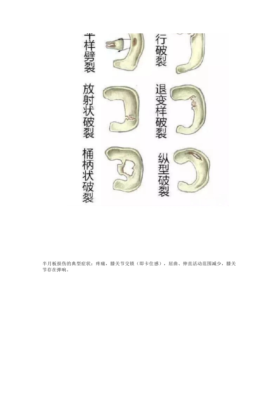 半月板的损伤 及治疗_第4页