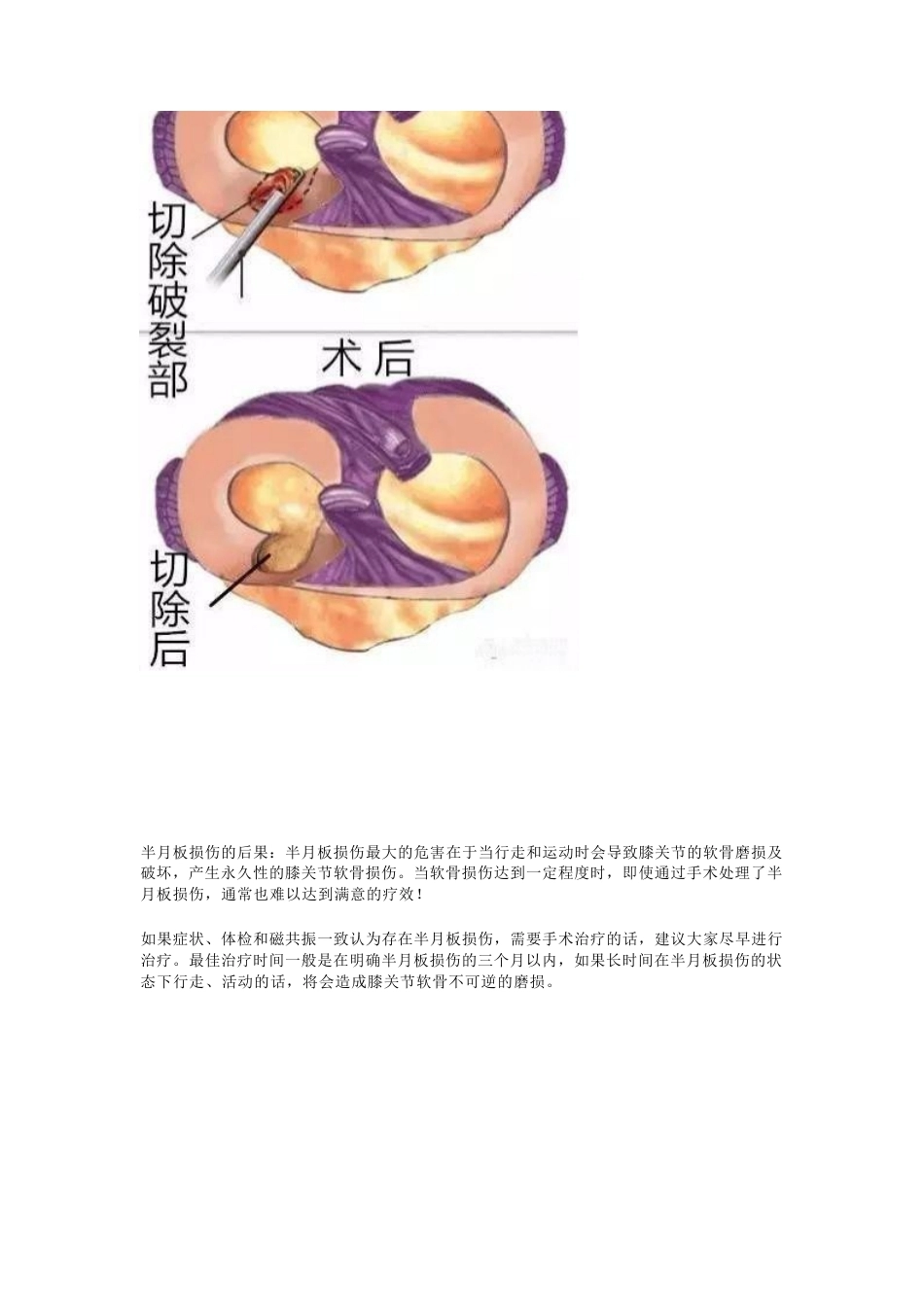 半月板的损伤 及治疗_第8页