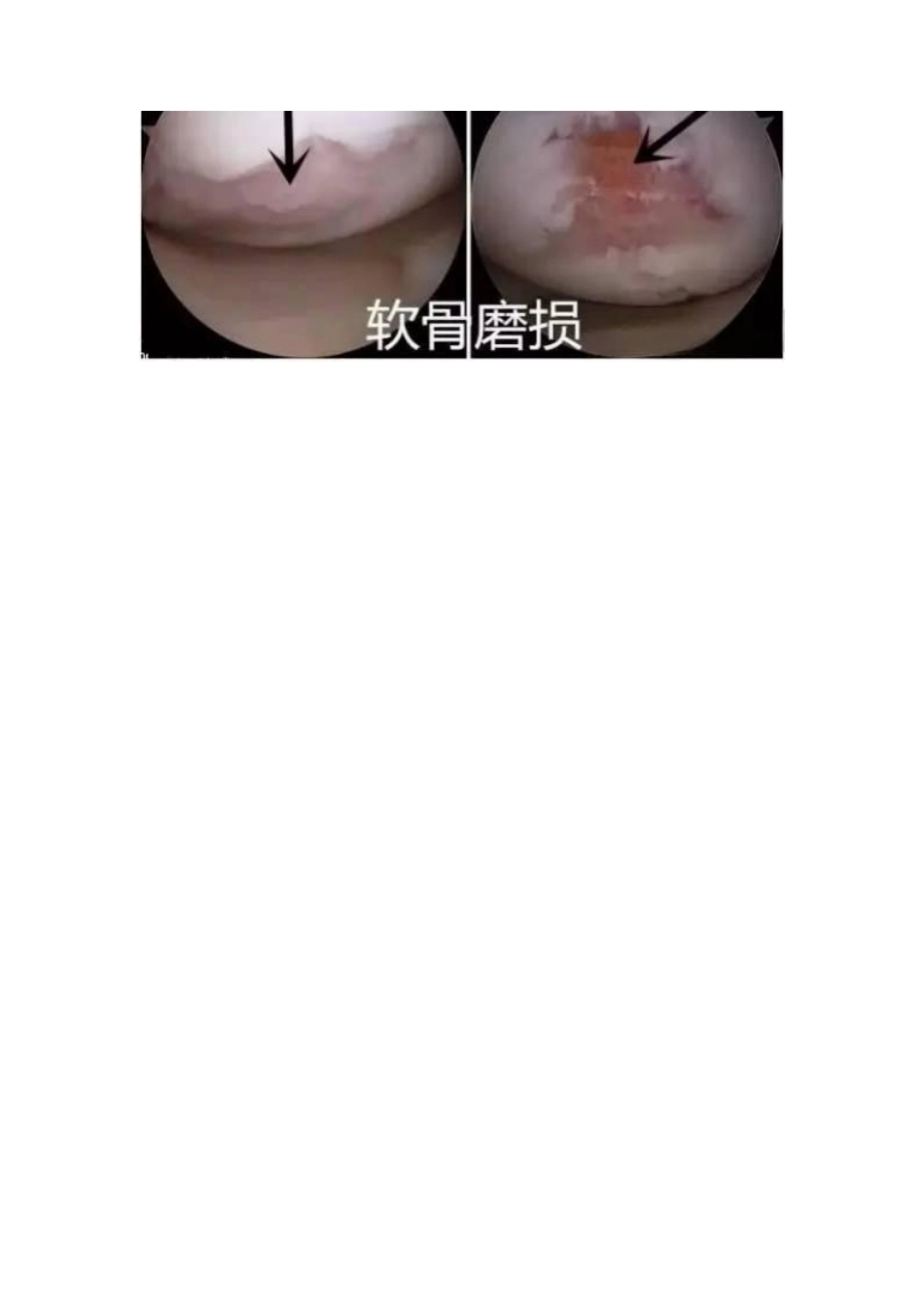 半月板的损伤 及治疗_第9页