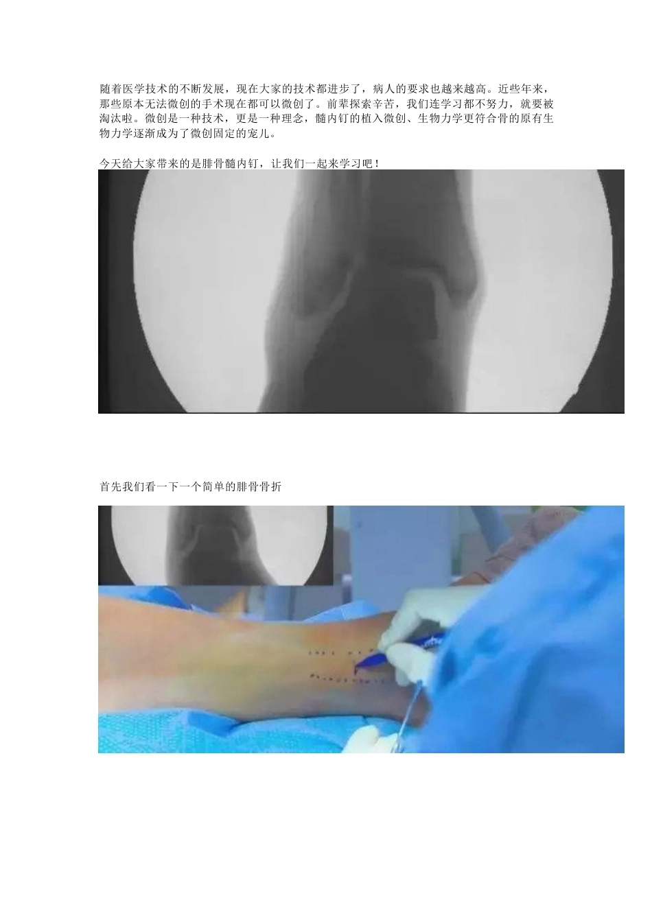 微创植入腓骨 髓内钉_第1页