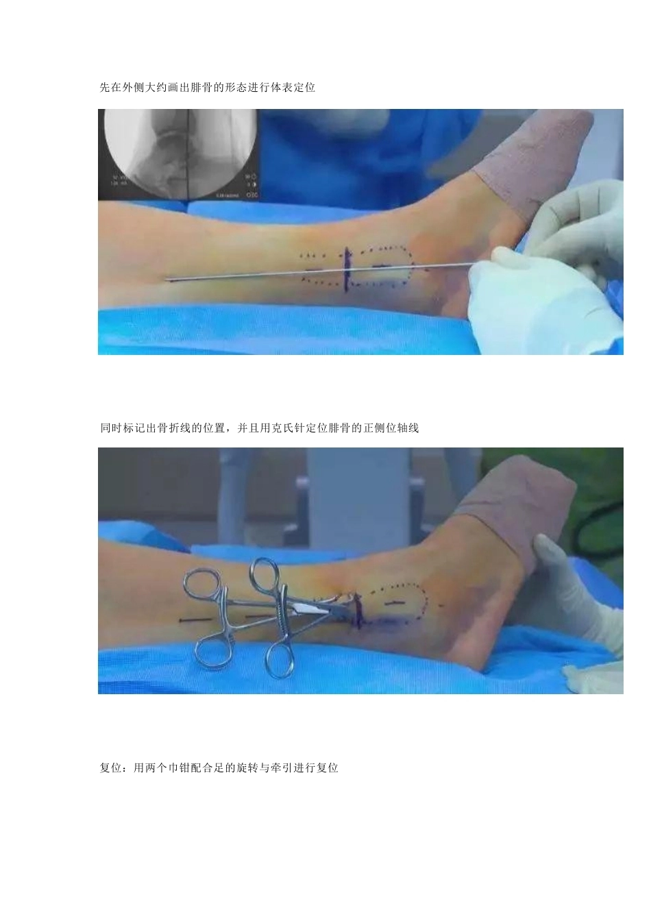 微创植入腓骨 髓内钉_第2页