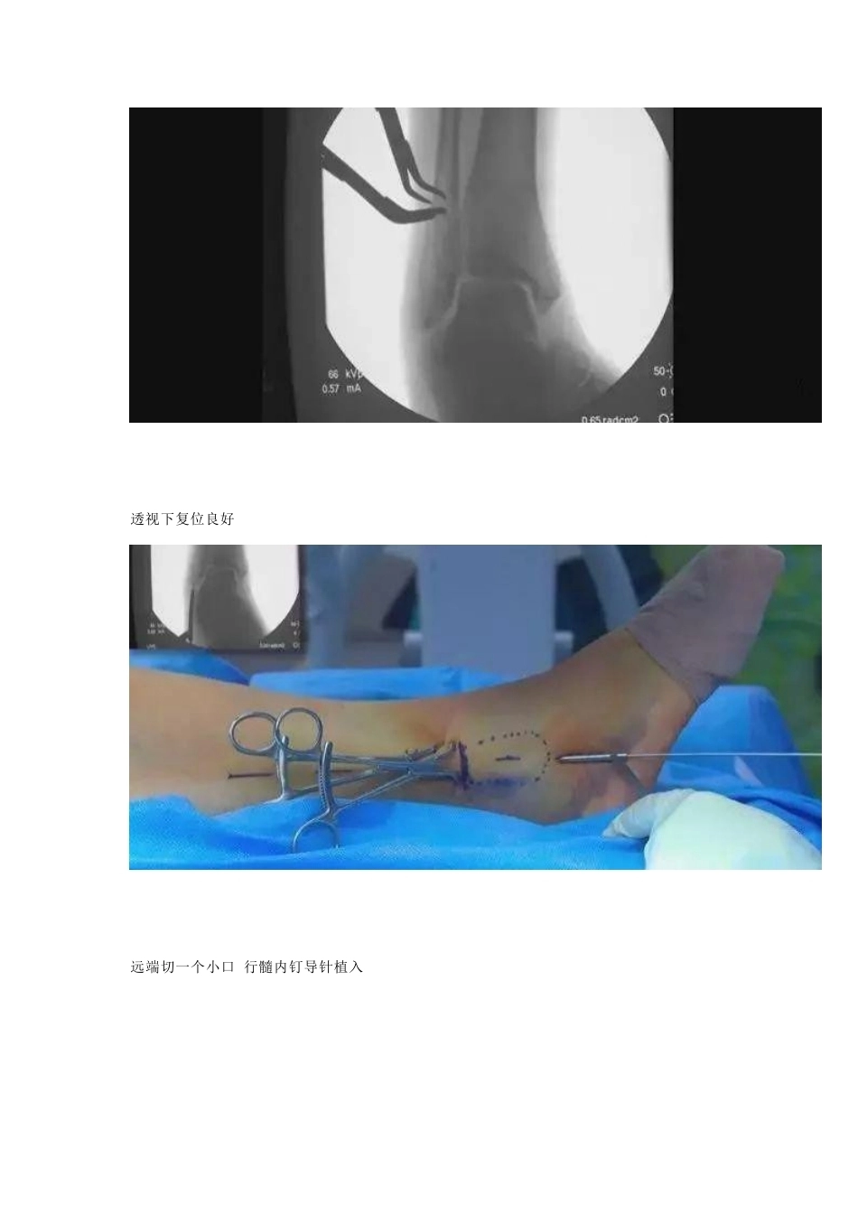 微创植入腓骨 髓内钉_第3页