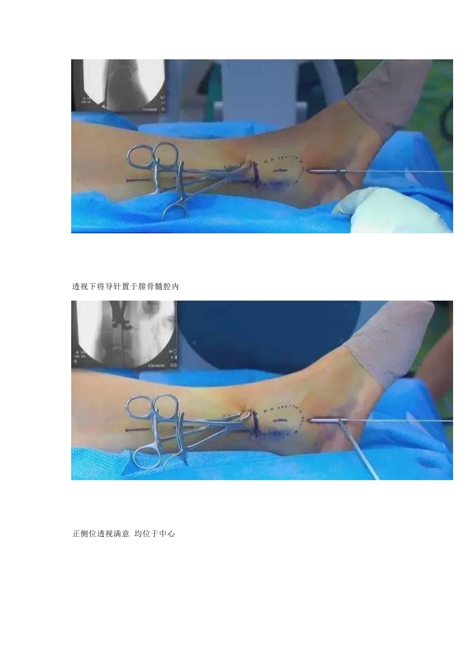 微创植入腓骨 髓内钉_第4页