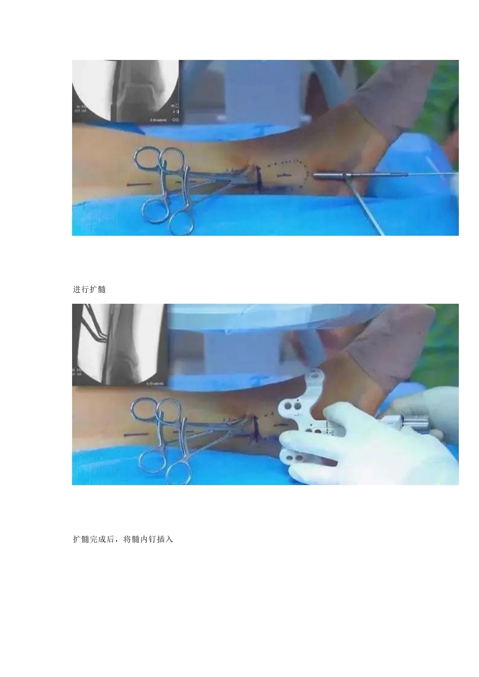 微创植入腓骨 髓内钉_第5页