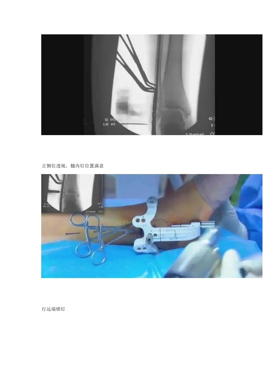 微创植入腓骨 髓内钉_第6页