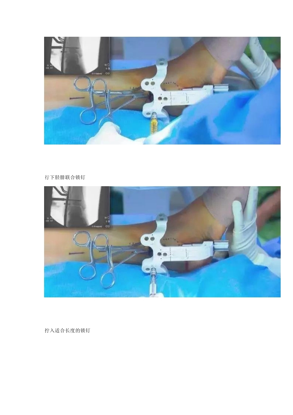 微创植入腓骨 髓内钉_第7页