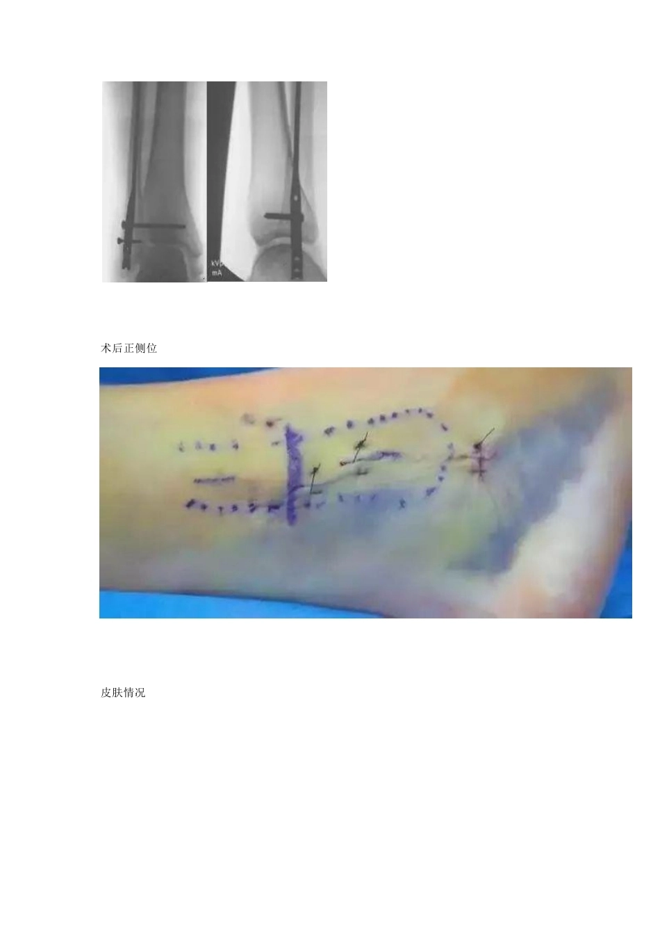 微创植入腓骨 髓内钉_第8页