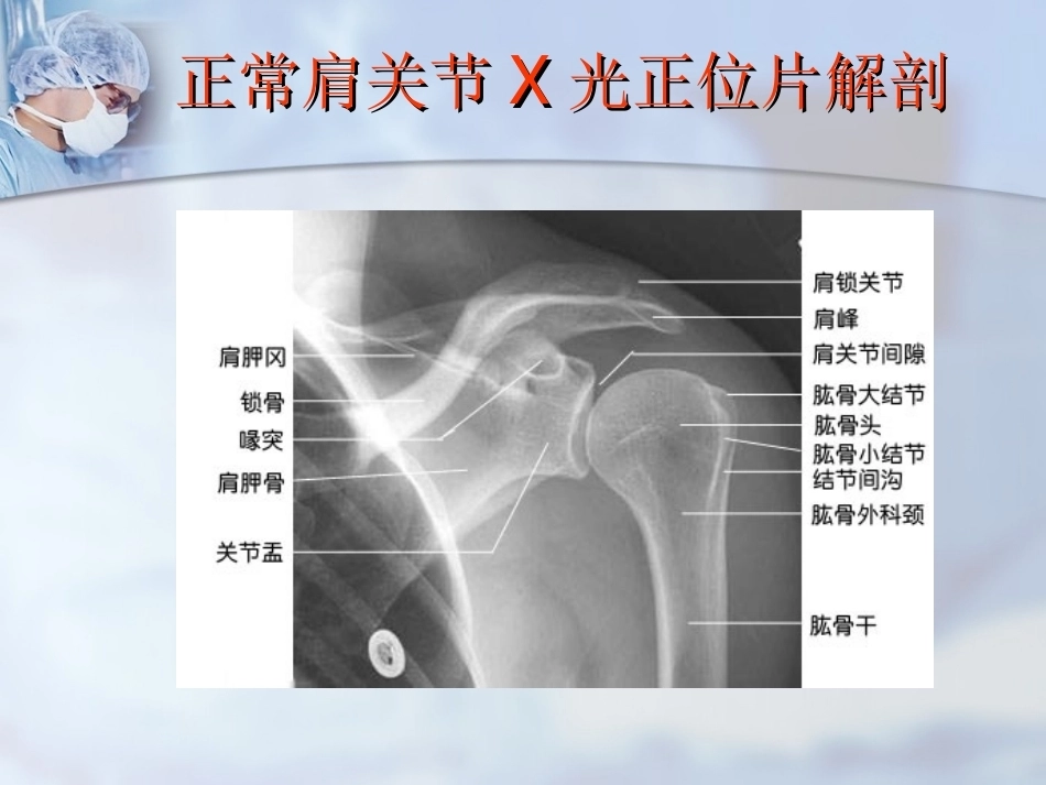 肱骨近端骨折分型与处理_第5页
