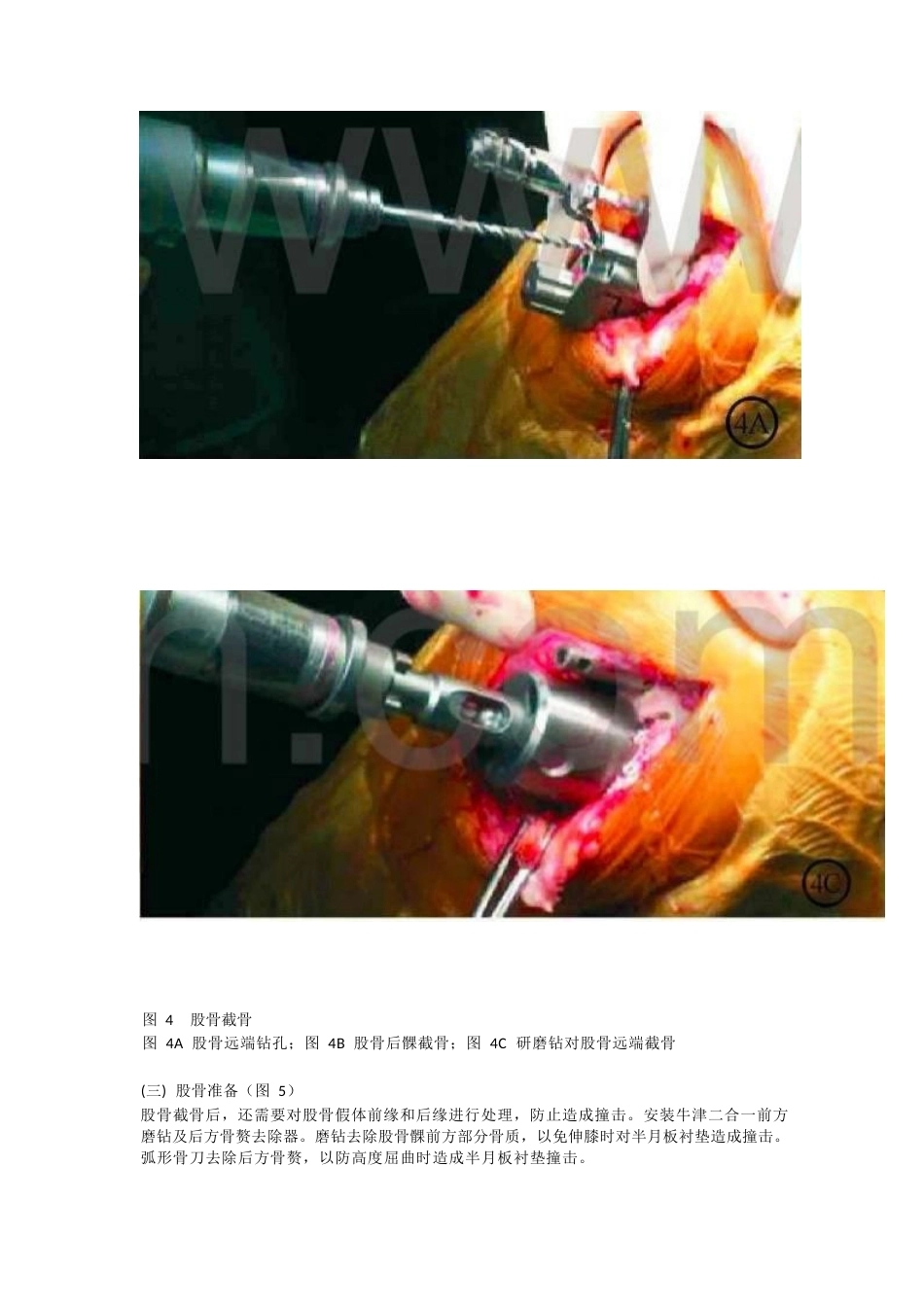 单髁关节置换 的手术技巧_第5页