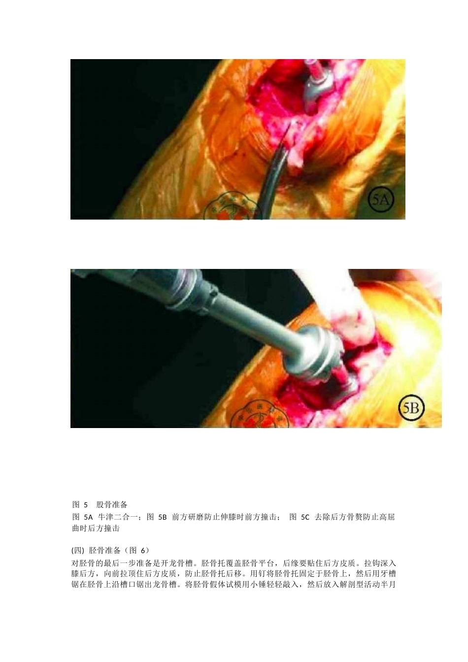 单髁关节置换 的手术技巧_第6页