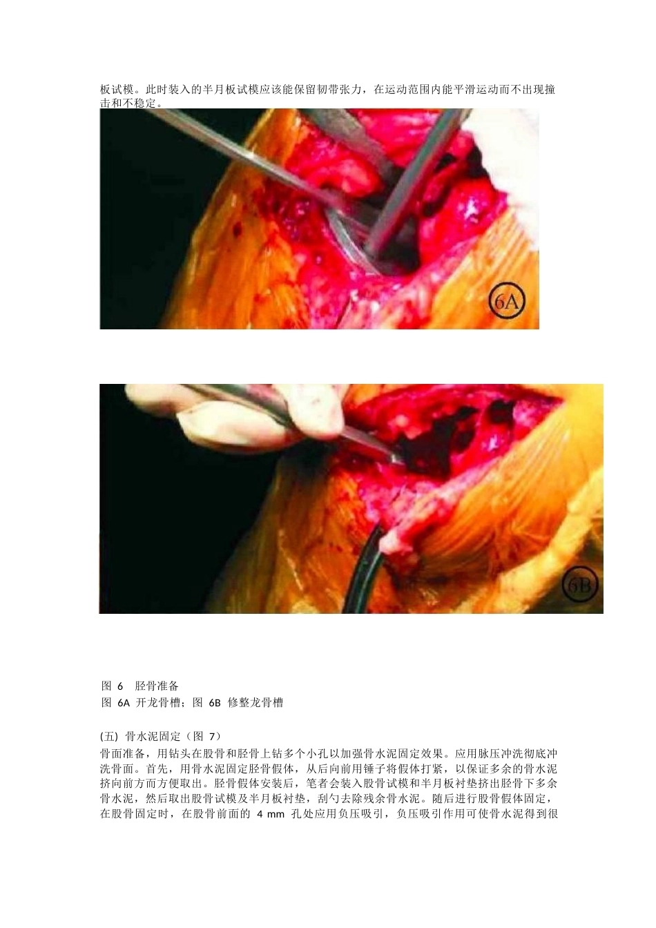 单髁关节置换 的手术技巧_第7页