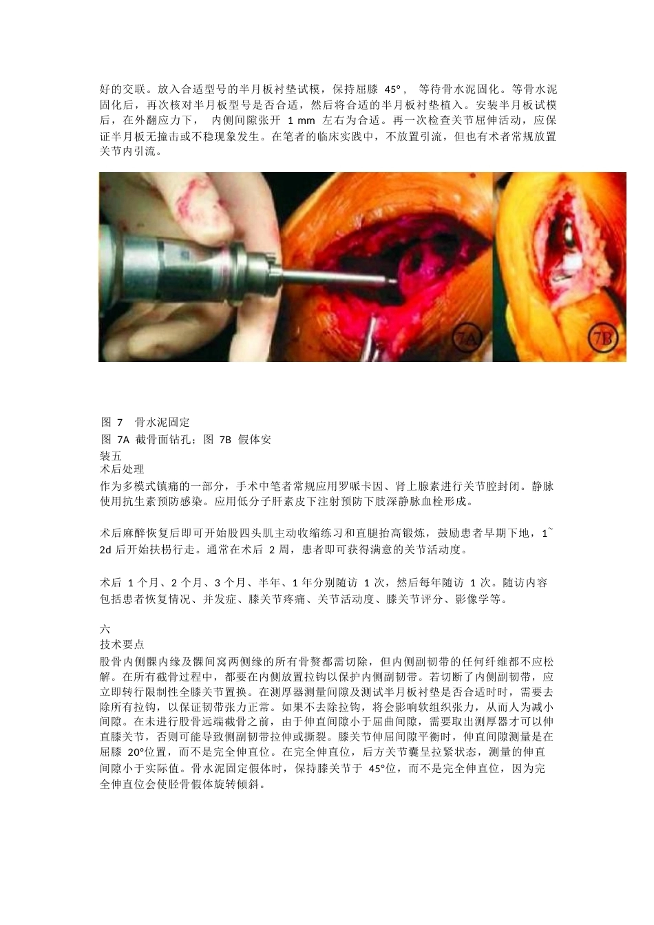 单髁关节置换 的手术技巧_第8页