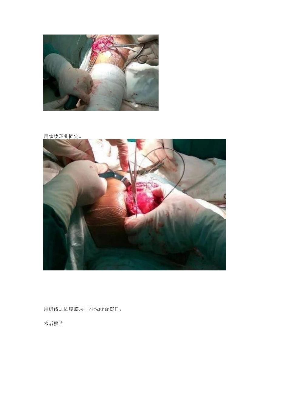 髌骨骨折的常见问 题及手术技巧_第11页