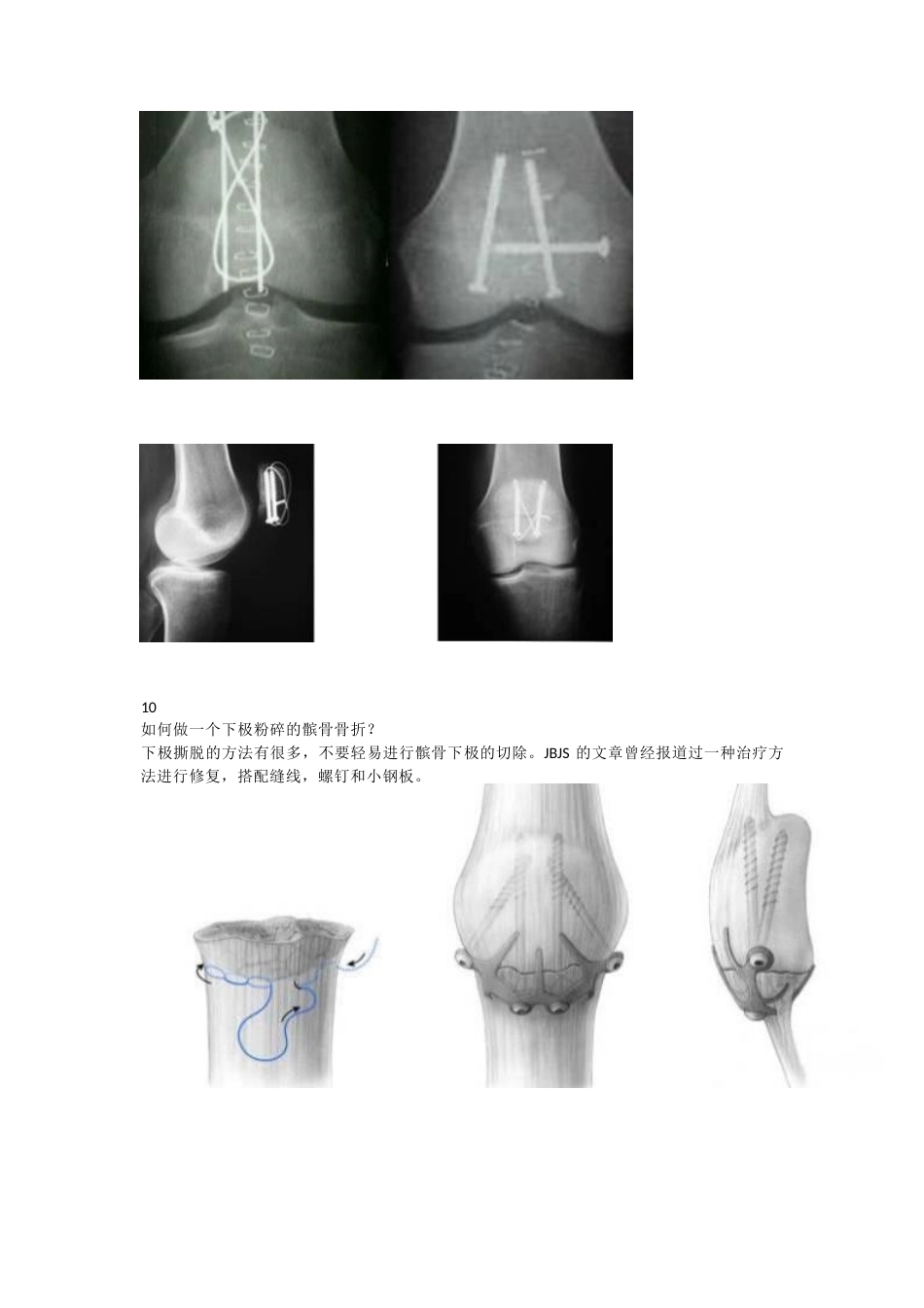 髌骨骨折的常见问 题及手术技巧_第5页
