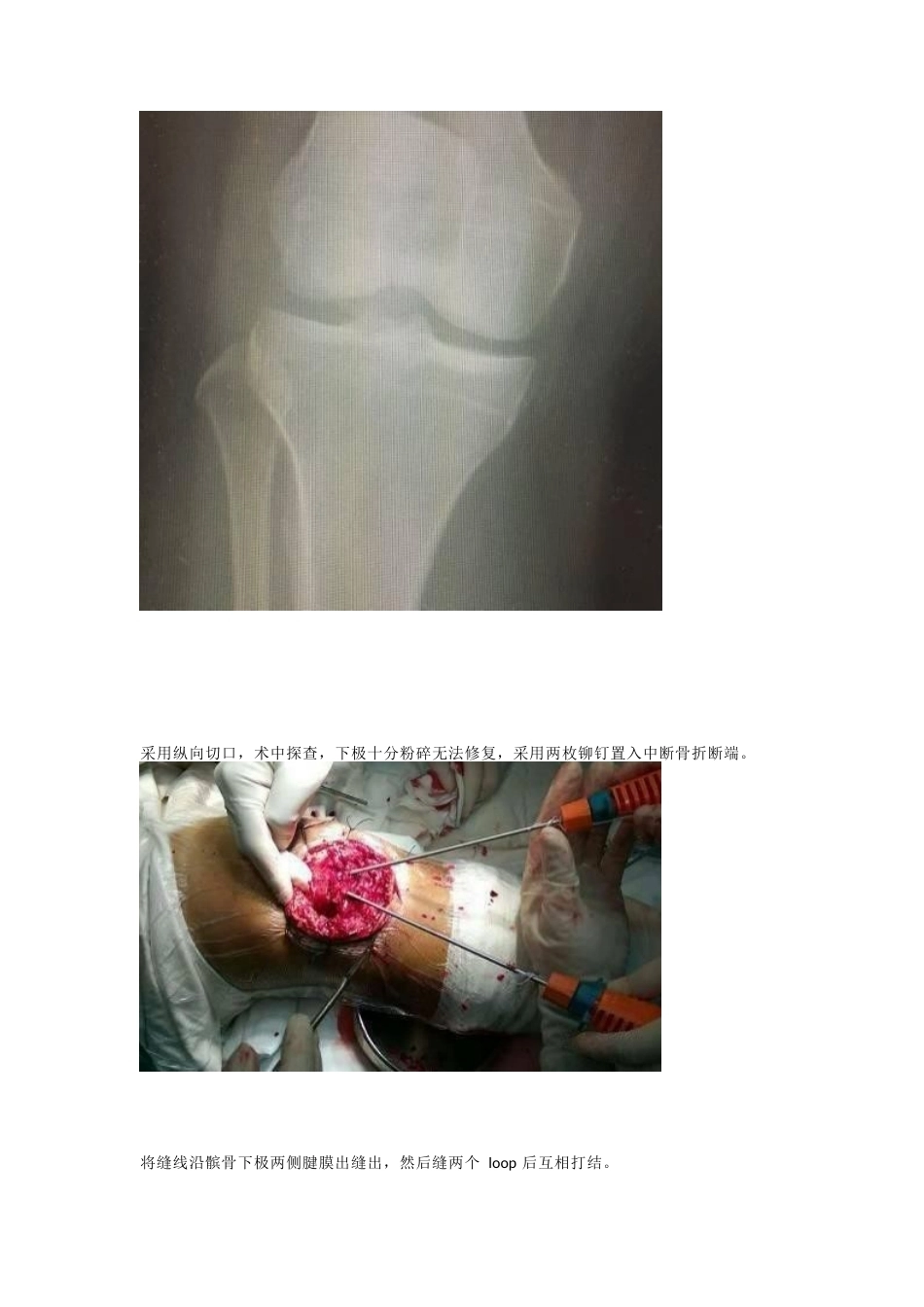 髌骨骨折的常见问 题及手术技巧_第8页