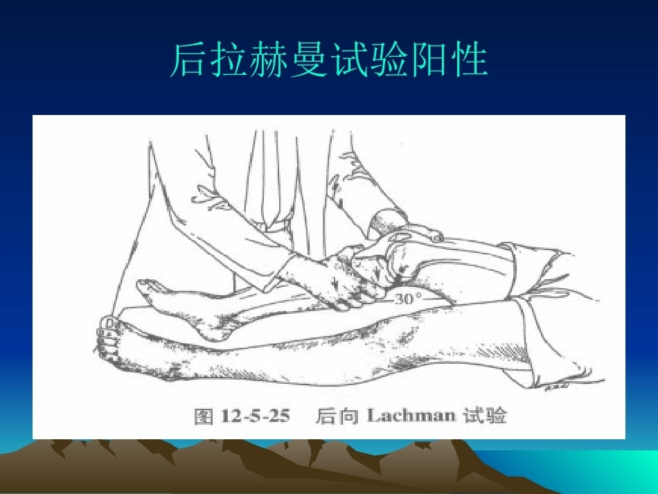 膝关节后交叉韧带 损伤_第14页
