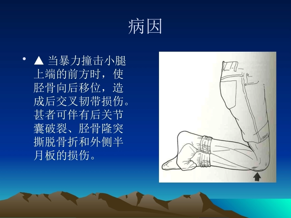膝关节后交叉韧带 损伤_第5页