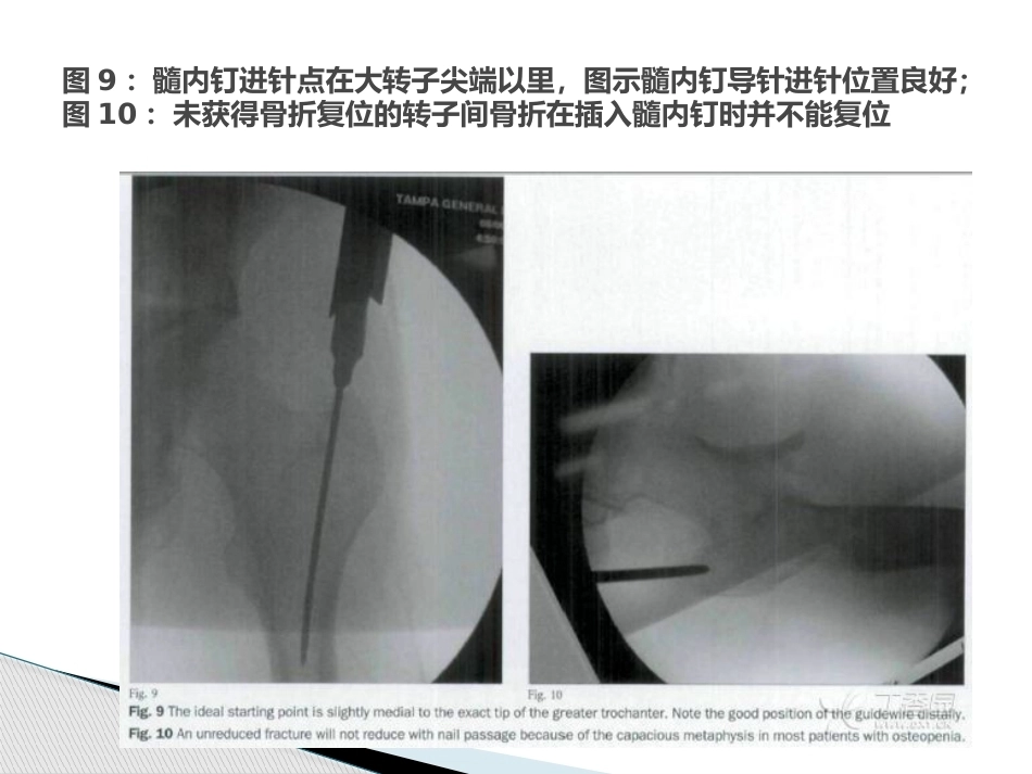 转子间骨折的十个手术技巧_第13页
