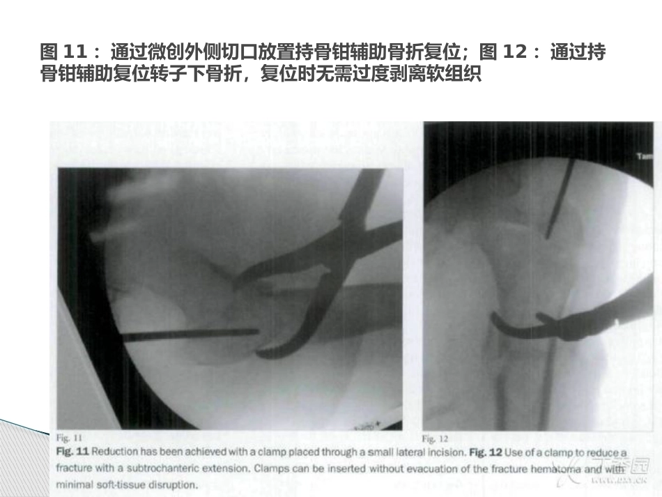 转子间骨折的十个手术技巧_第15页