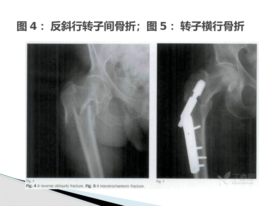 转子间骨折的十个手术技巧_第8页