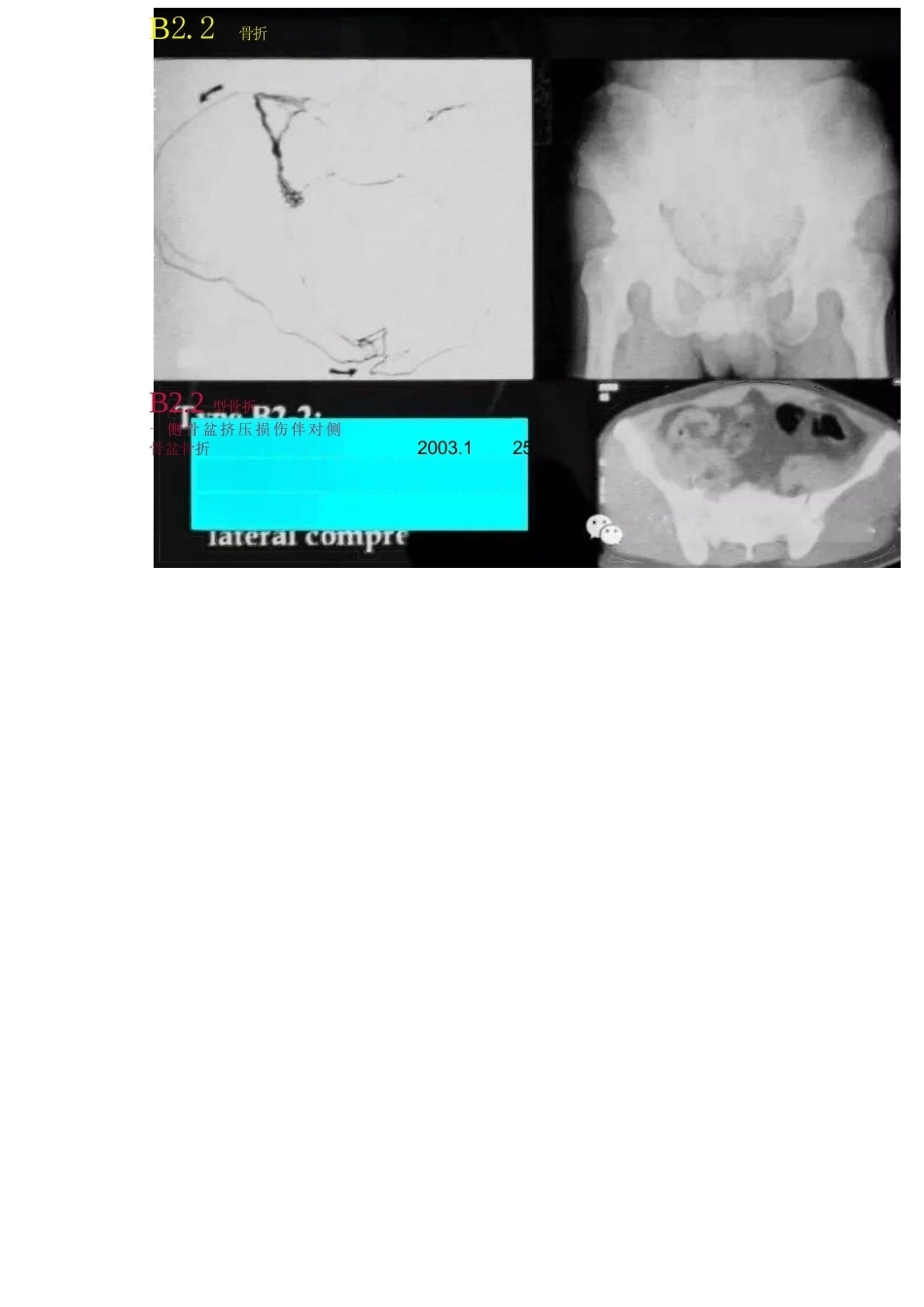 骨盆骨折的分型、图解_第10页