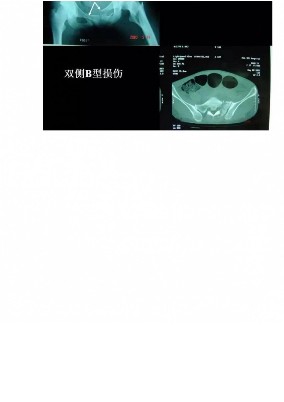 骨盆骨折的分型、图解_第12页