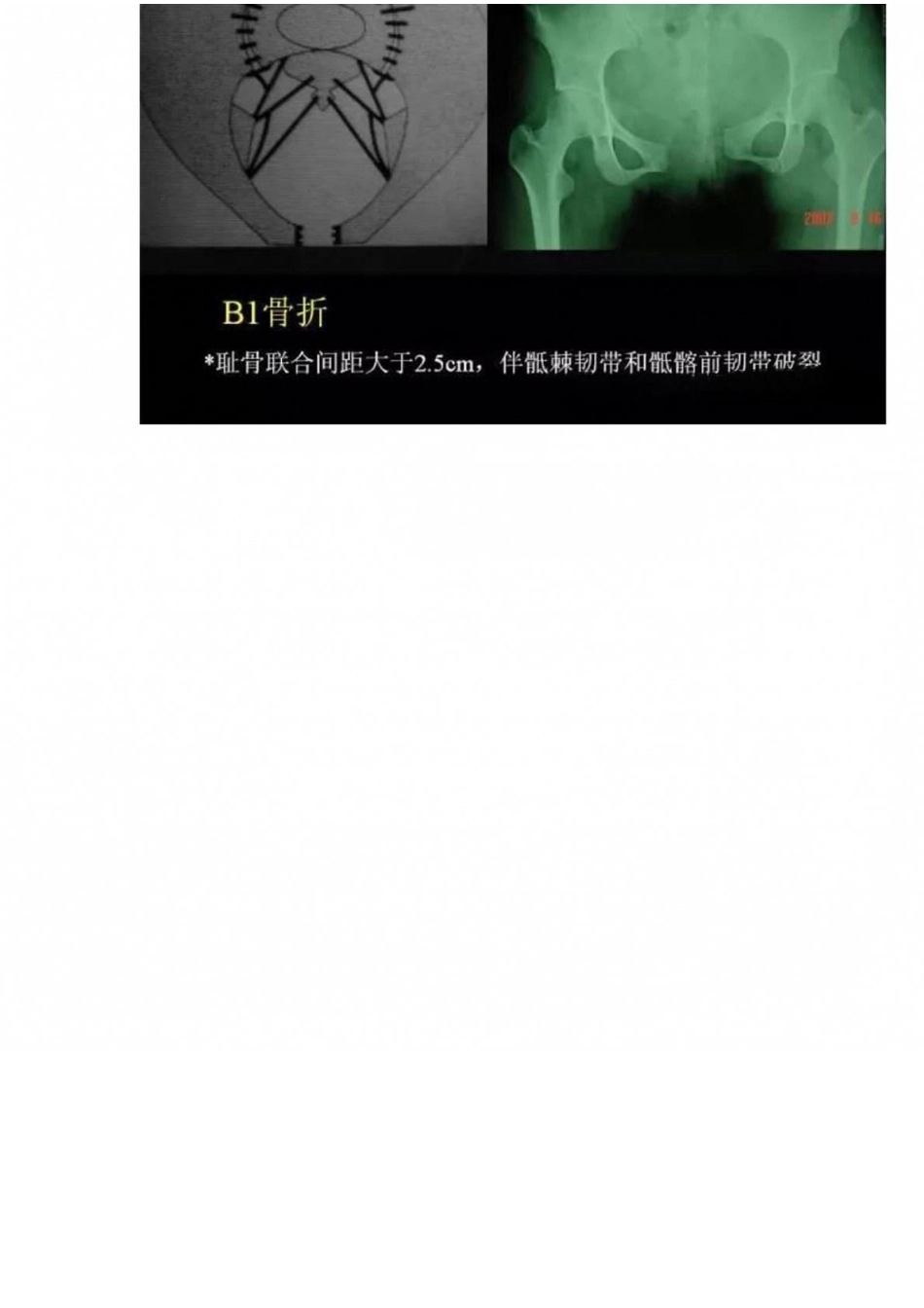 骨盆骨折的分型、图解_第5页