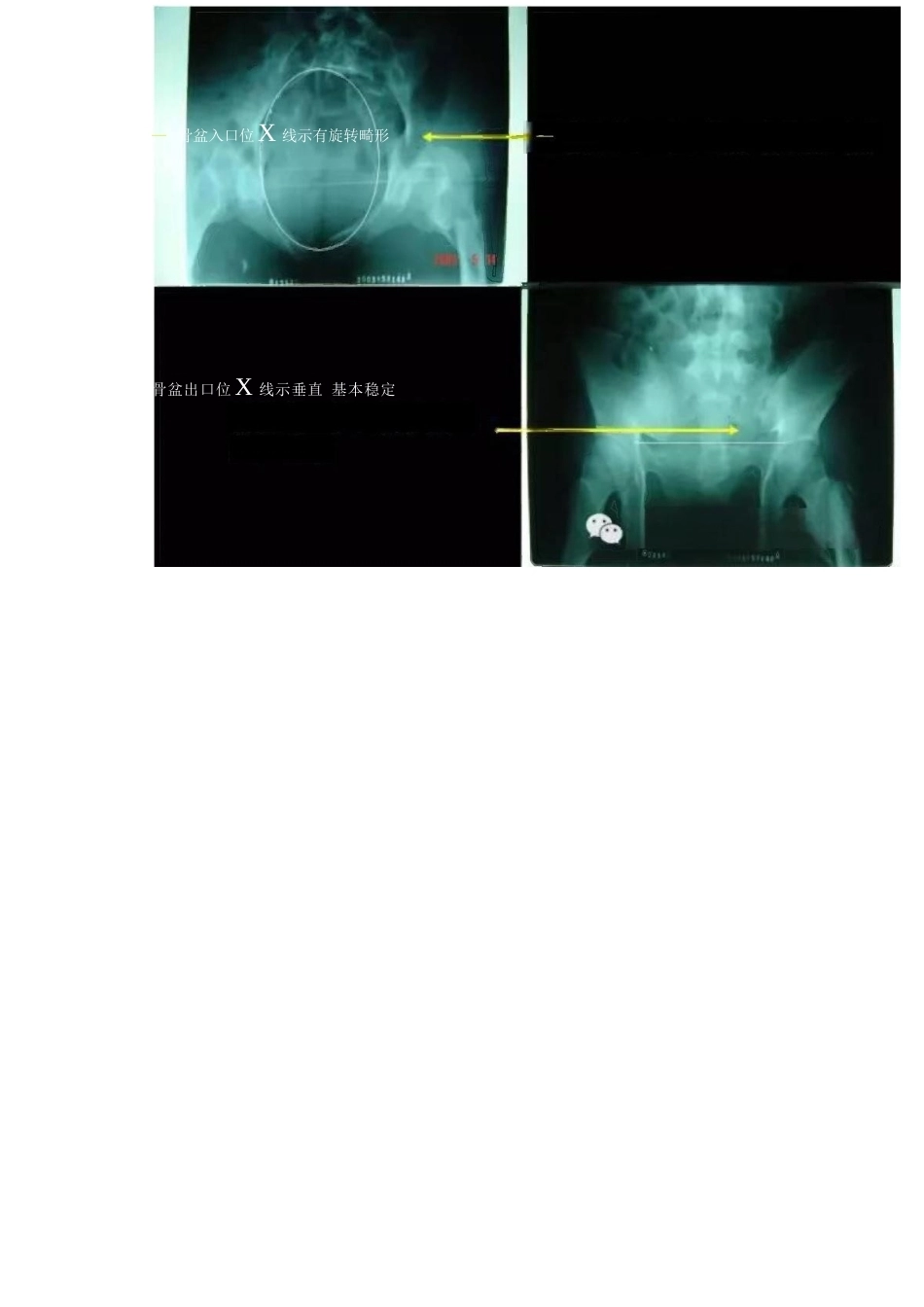 骨盆骨折的分型、图解_第8页